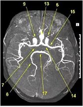 mrt-angiografiya-arterialnyh-sosudov-golovnogo-mozga-v-aksialnoj-proektsii
