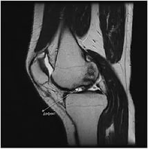 mrt-tomografiya-kolennogo-sustava-v-sagittalnoj-proektsii-defekt-kosti