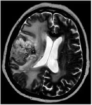 magnitno-rezonansnaya-tomografiya-mrt-golovnogo-mozga-opuhol